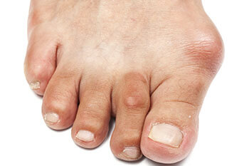 Bunions treatment and Removal in the Lehi, UT 84043 and Murray, UT 84123