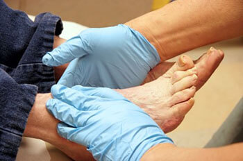 Diabetic foot treatment, Management of Diabetic Foot Ulcers in the Lehi, UT 84043 and Murray, UT 84123 area