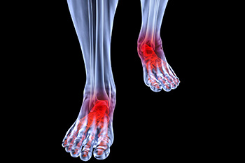 Arthritic foot and ankle care treatment in the Lehi, UT 84043 and Murray, UT 84123 area