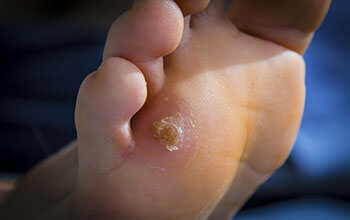 Corns and Calluses treatment in the Lehi, UT 84043 and Murray, UT 84123