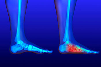 Flat feet and Fallen Arches treatment in the Lehi, UT 84043 and Murray, UT 84123
