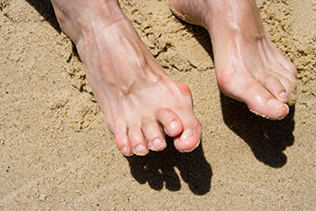 Hammertoes treatment in the Lehi, UT 84043 and Murray, UT 84123