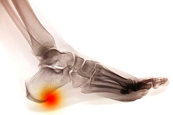 Heel spurs treatment in the Lehi, UT 84043 and Murray, UT 84123 area