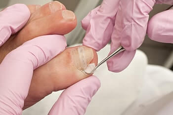 Ingrown toenails treatment in the Lehi, UT 84043 and Murray, UT 84123 area