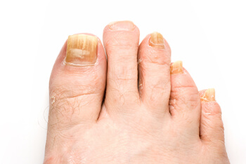 Fungal toenails treatment in the Lehi, UT 84043 and Murray, UT 84123 area