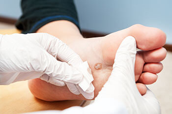 Plantar warts treatment in the Lehi, UT 84043 and Murray, UT 84123 area