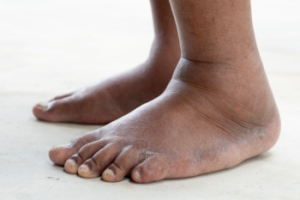 Common Causes of Swollen Ankles and Effective Relief Methods